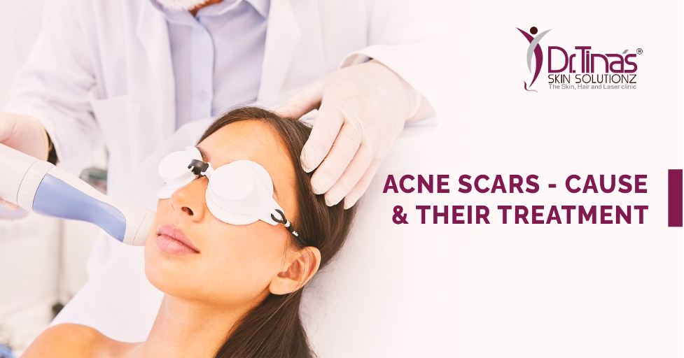 Acne Scars Treatment In Bangalore