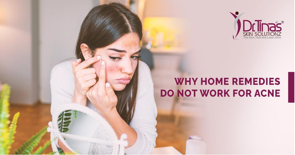 Why Home Remedies may not Work for Acne - Skin Solutionz