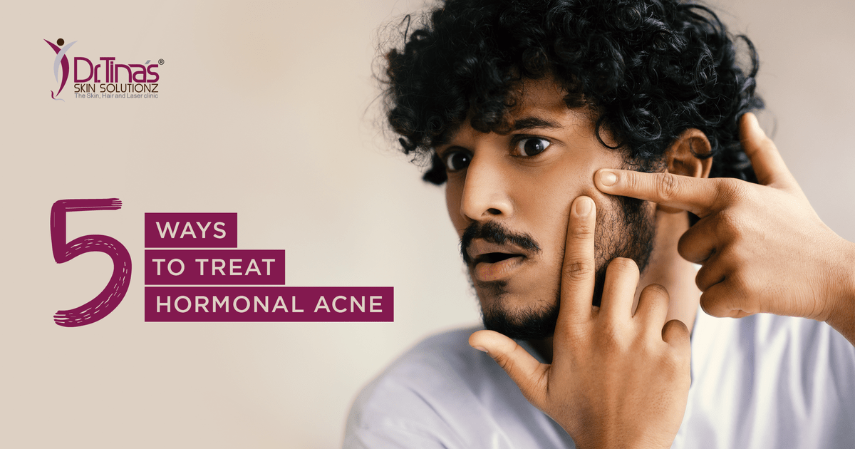 5 Ways to Treat Hormonal Acne