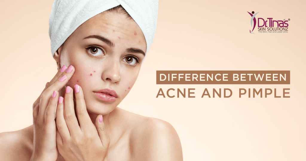 Final. Acne vs Pimples Do You Know The Differences