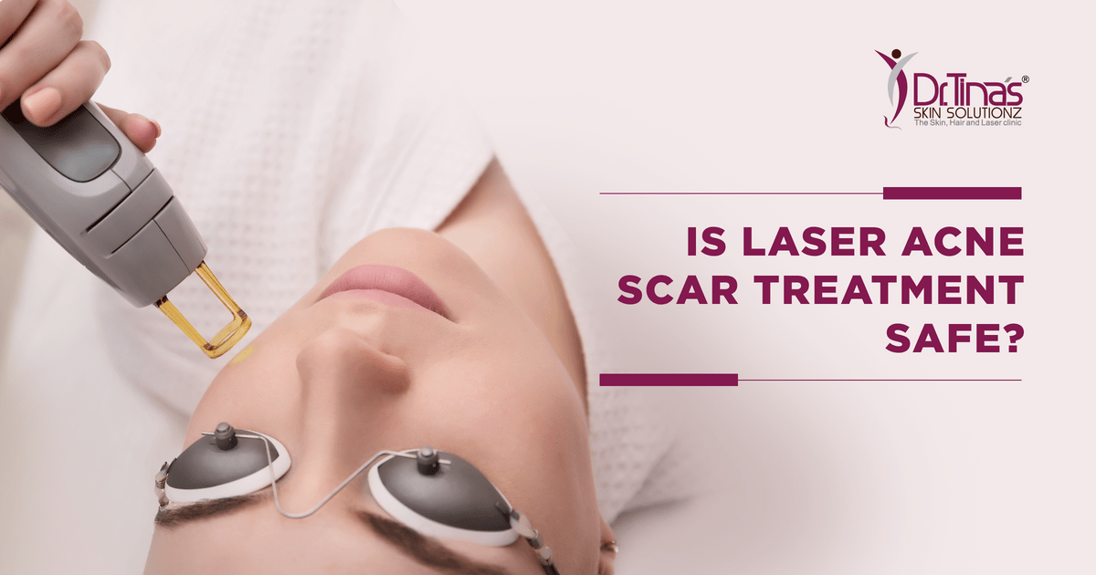 Is Laser Treatment For Acne Scars Safe?