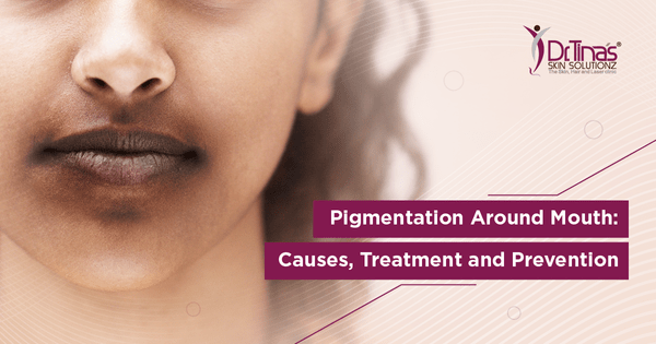 Pigmentation Around Mouth: Causes, Treatment and Prevention