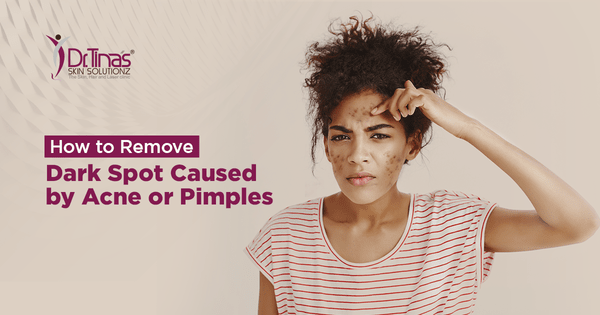 How to Remove Dark Spot Caused by Acne or Pimples 2