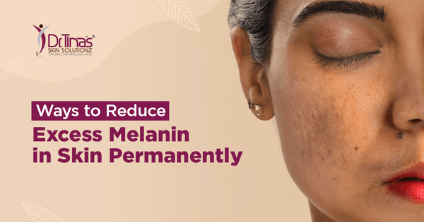 Ways to Reduce Excess Melanin in Skin Permanently