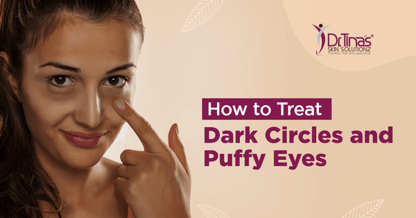 How to Treat Dark Circles and Puffy Eyes