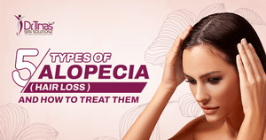 5 Types of Alopecia (Hair Loss) and How to Treat Them