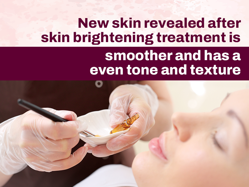 Chemical peel leaves a smooth and even tone texture 