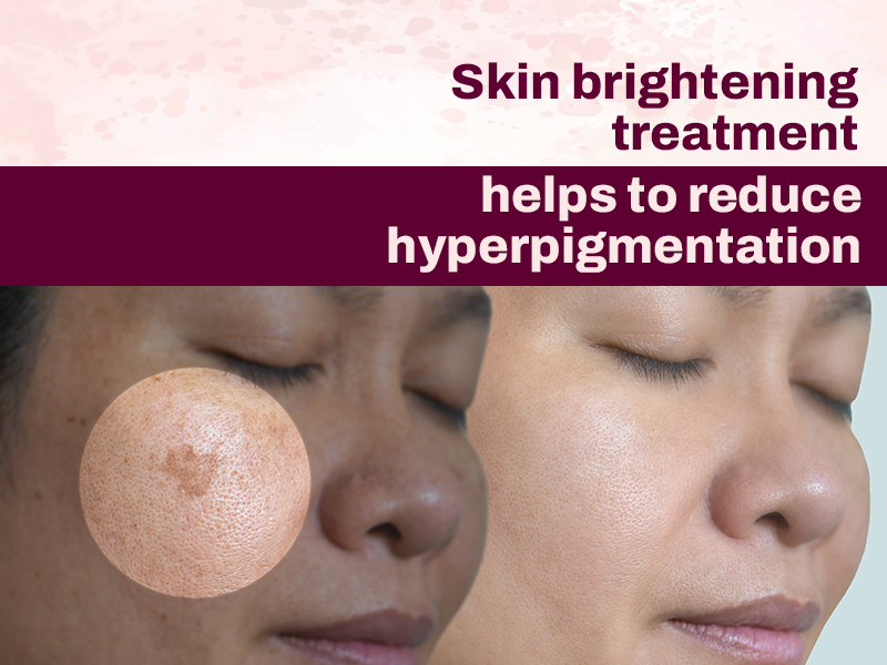 Skin Brightening Treatment Reduces Pigmentation 
