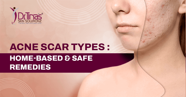 Acne Scar Type 1