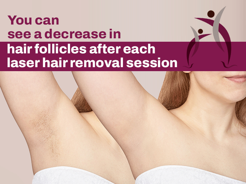 Hair Follicles are reduced after each laser hair removal session 