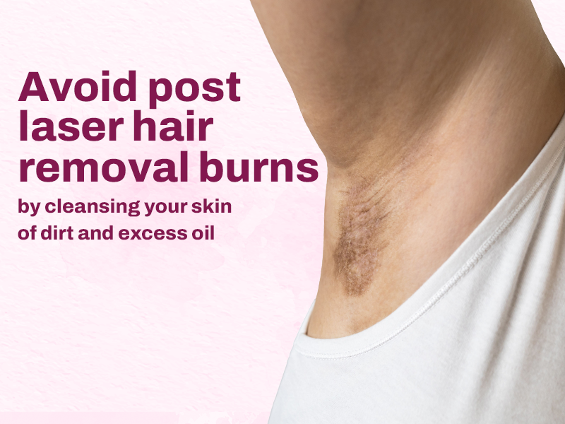 Cleanse your skin of excess dirt and oil to avoid burns