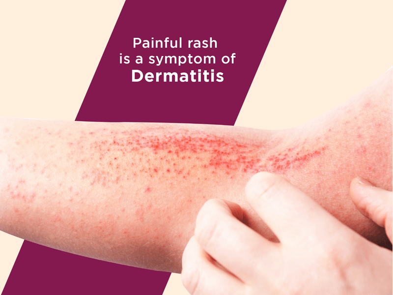Painful rash is a symptom of dermatitis