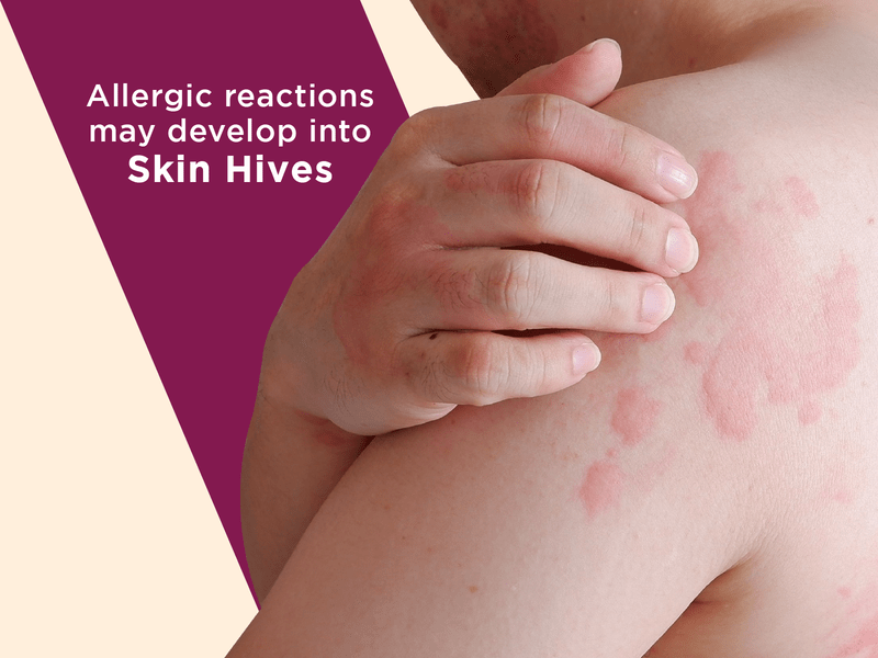 Allergic reactions may develop into hives