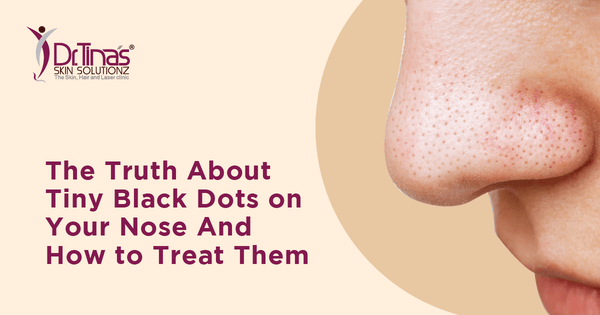 Truth About Tiny Black Dots on Your Nose