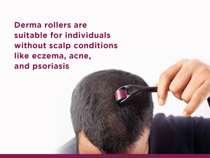 Derma rollers are suitable for scalp conditions