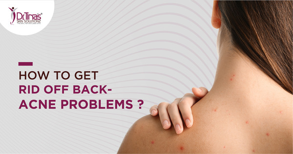 Say Goodbye to Back Acne Scars: Effective Strategies for Treatment