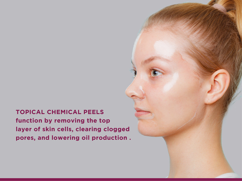 Topical chemical peels for controlling back acne