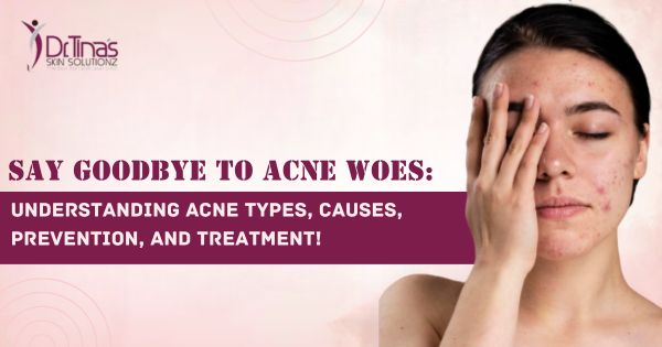 Acne 101: A Comprehensive Guide to Understanding Acne Types, Causes, Prevention, and Treatment!