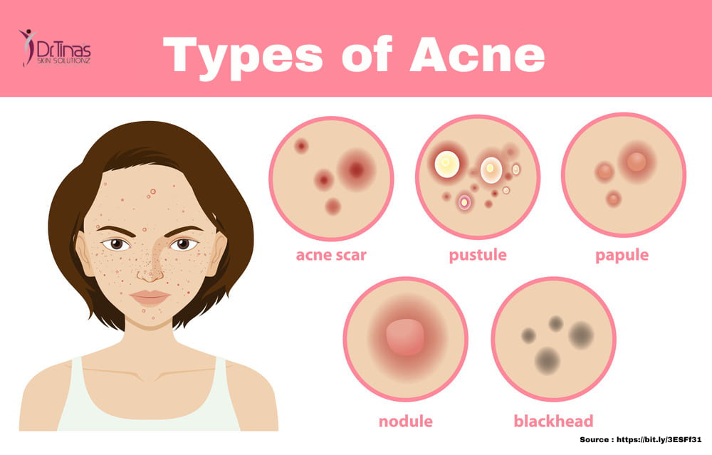 Types of acne