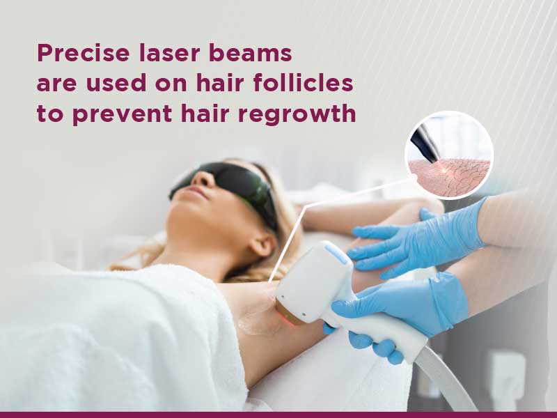 Laser hair removal provides long term solution