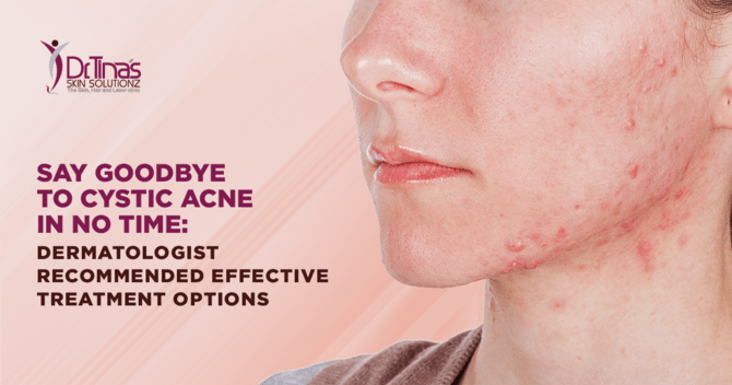 Say Goodbye to Cystic Acne in No Time: Dermatologist Recommended Effective Treatment Options 