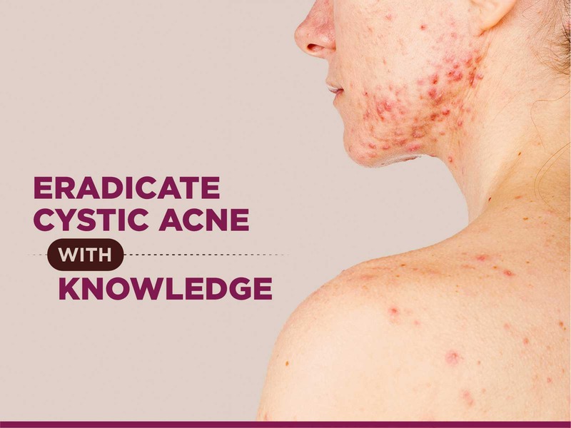 Cystic acne treatment in bangalore