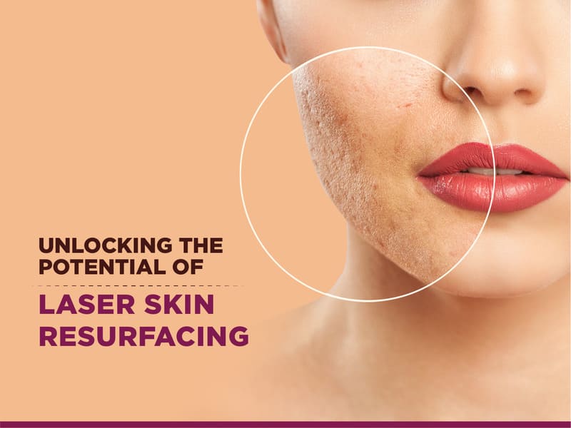 laser skin resurfacing treatments