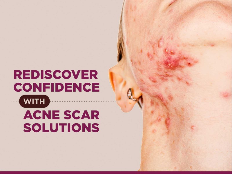 Cystic acne scar treatment in Bangalore