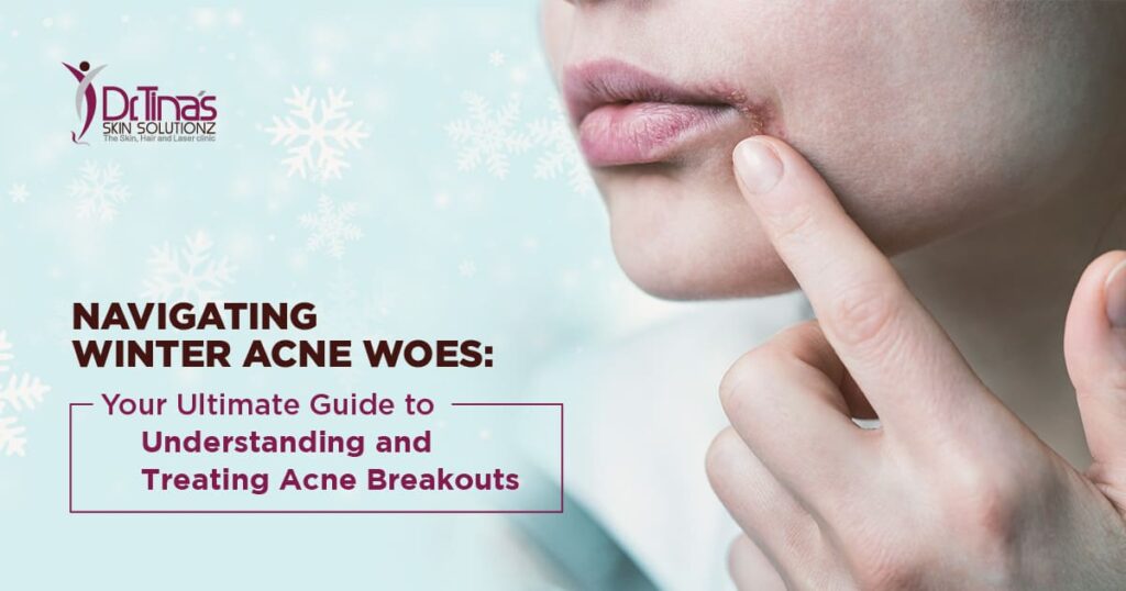 Acne breakout treatment