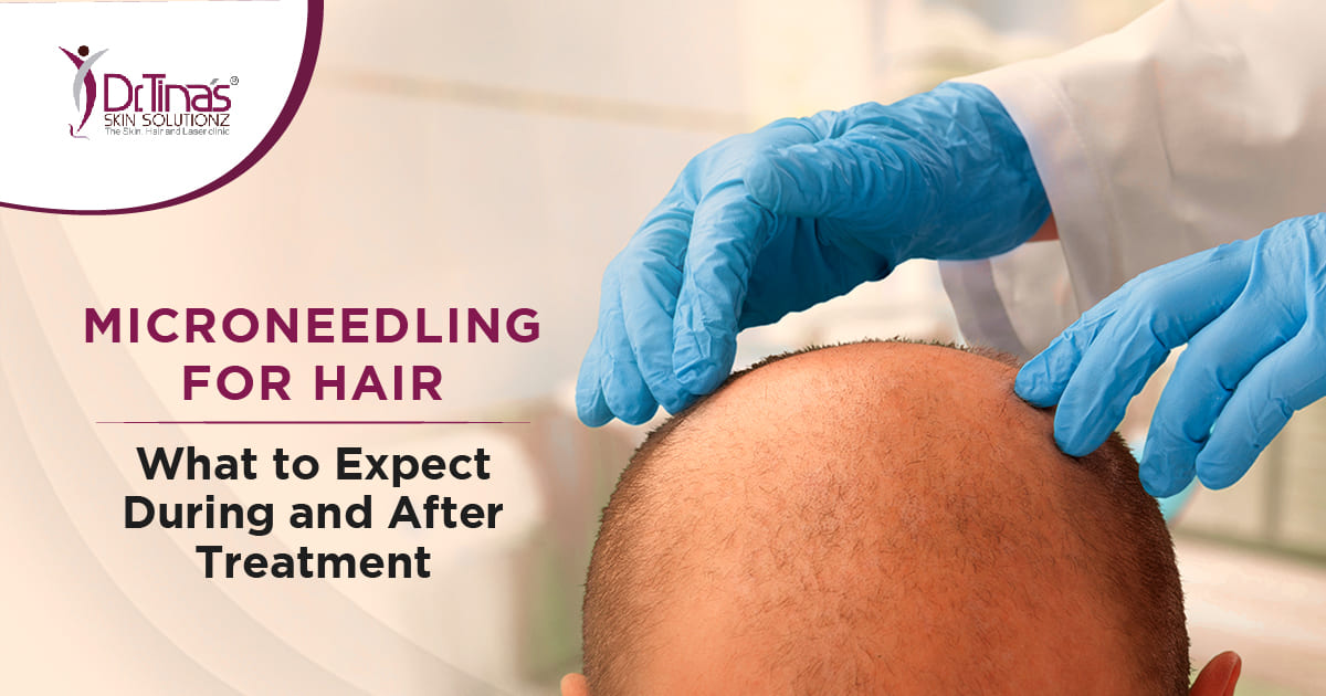 Microneedling for Hair: What to Expect During and After Treatment 