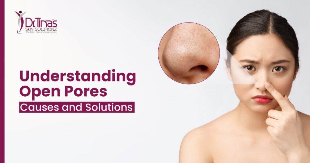 Understanding Open Pores: Causes and Solutions 1 Understanding Open Pores