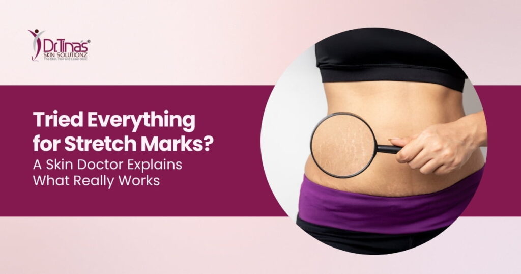 Tried Everything for Stretch Marks? A Skin Doctor Explains What Really Works 1 Tried Everything for Stretch Marks? A Skin Doctor Explains What Really Works