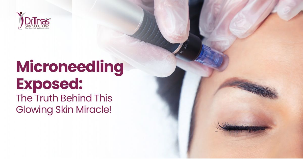 Microneedling Exposed: The Truth Behind This Glowing Skin Miracle!