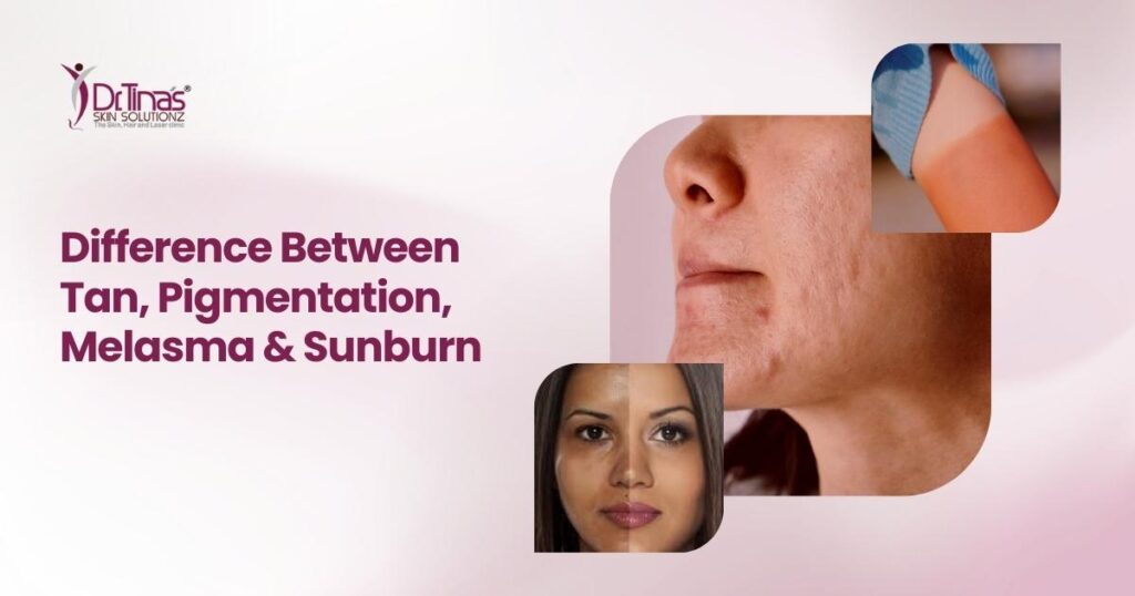 Difference Between Tan, Pigmentation, Melasma and Sunburn