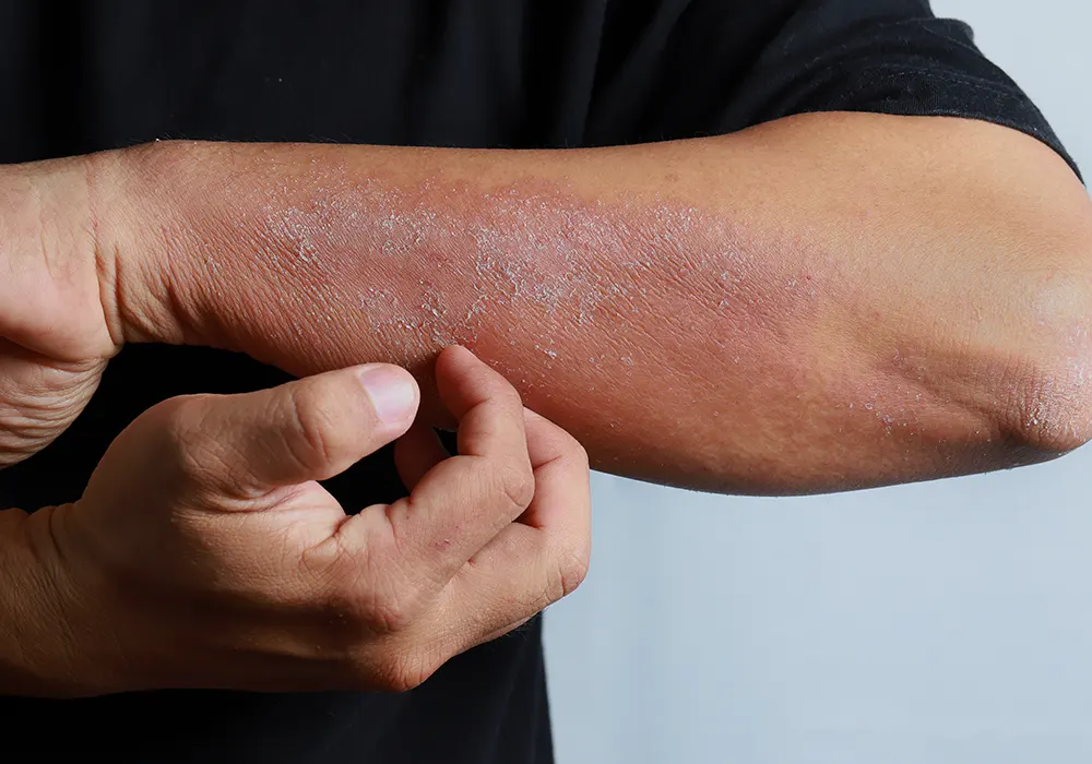 Atopic dermatitis skin allergy