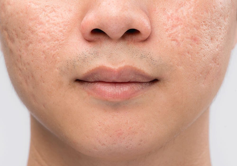 Atrophic acne scars