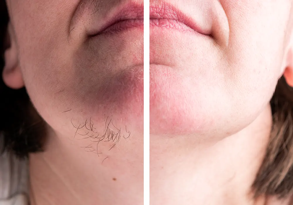 Before and after of unwanted chin hair removal