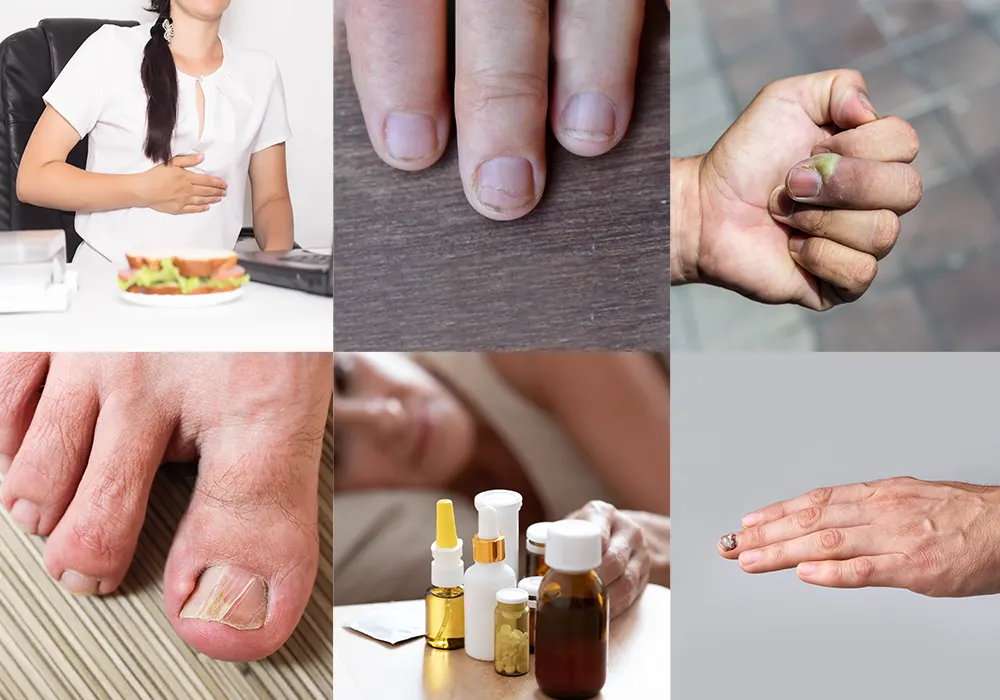 Nail discoloration causes