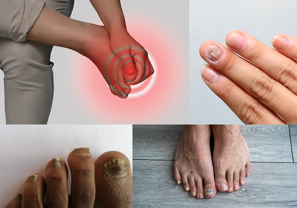 Common signs of fungal nail infection