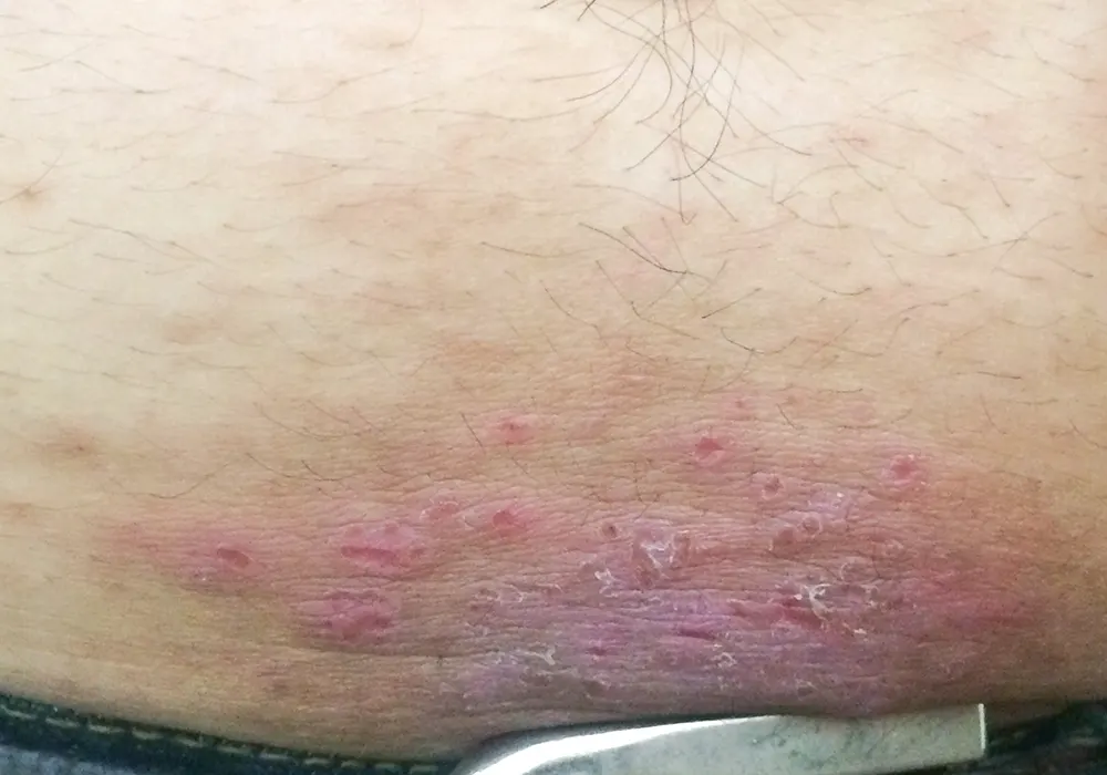 Contact dermatitis treatment in Bangalore