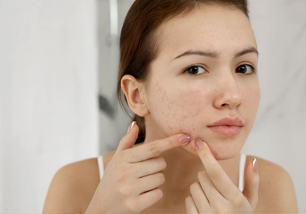 Acne scars in women
