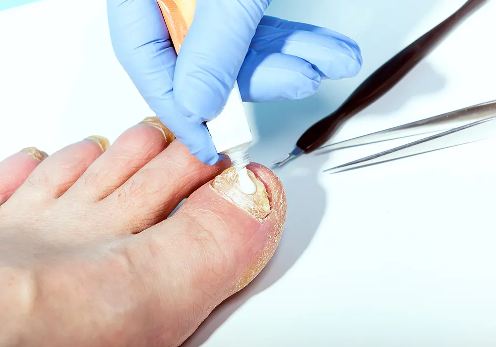 Effective Treatments for Toenail Fungus - GoodRx