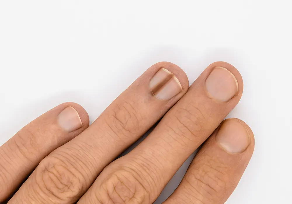 Melanocytic activation in nails