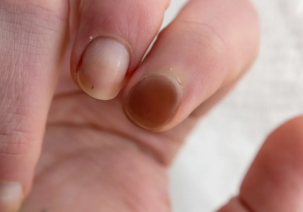 Melanocytic hyperplasia in nails