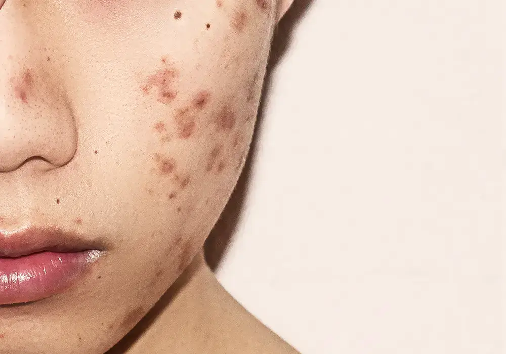 Post Inflammatory hyperpigmentation acne