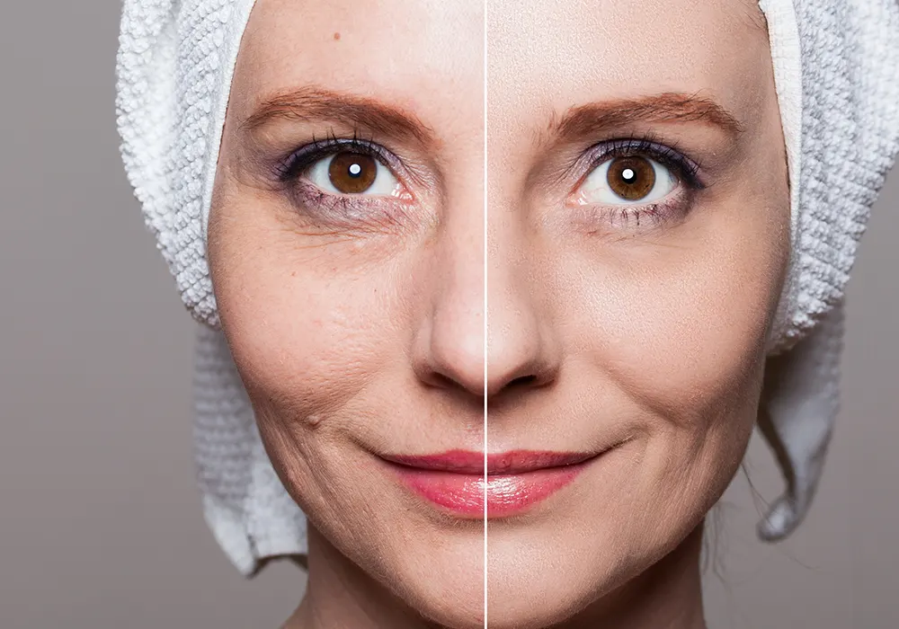 before and after anti ageing treatment in Bangalore