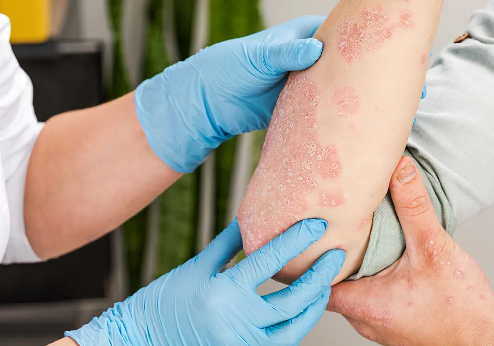 Skin Allergy treatments in Bangalore