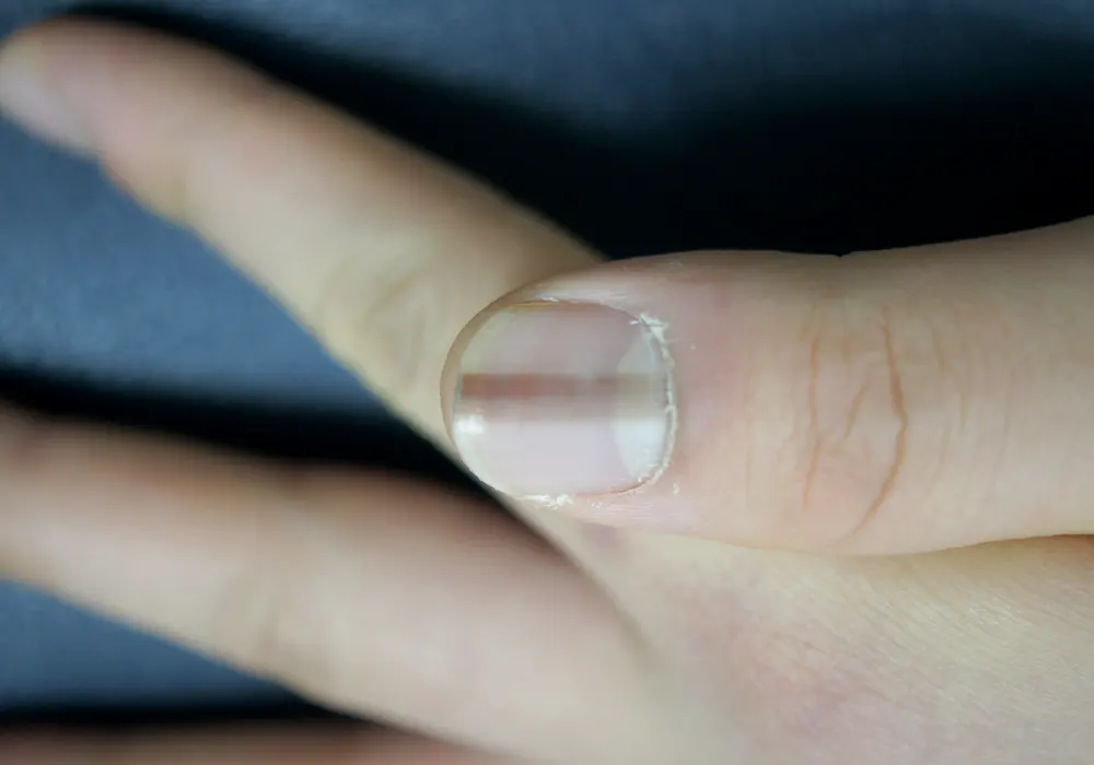 Symptom of Melanonychia on fingernails