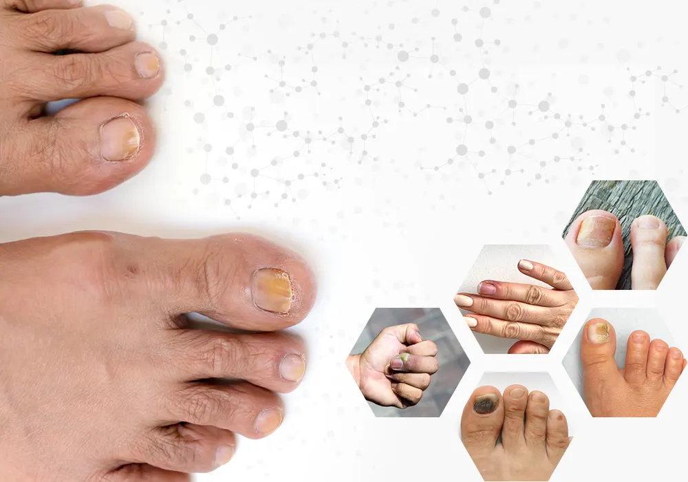 Symptoms of Nail Discoloration