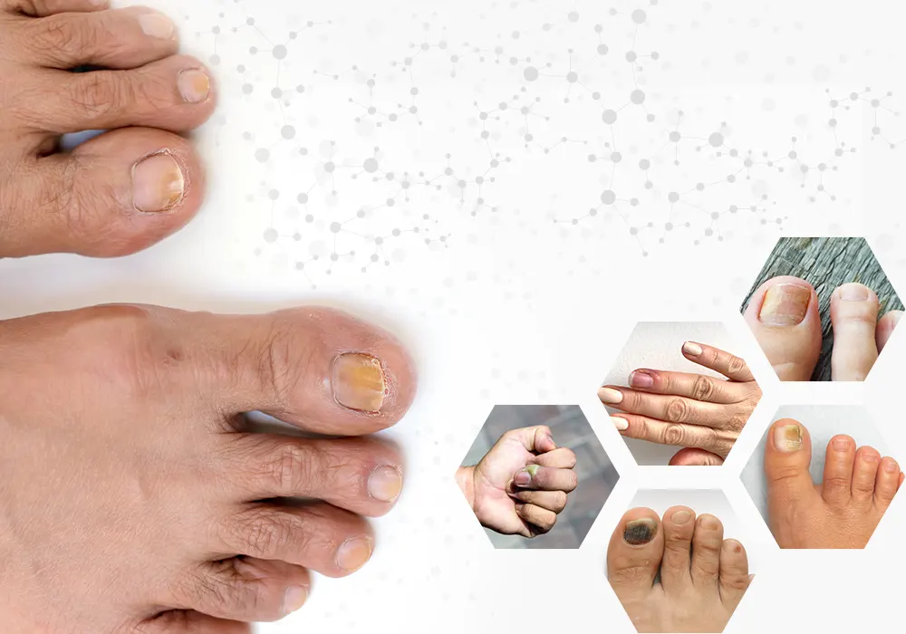 Toenail Fungus in Jacksonville, FL | Meridian Podiatry Clinic